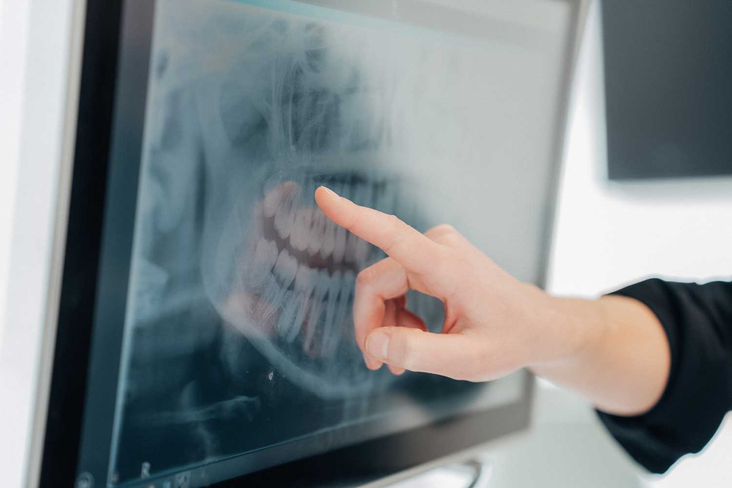 Eine Zahnärztin von NOVA-Z zeigt mit ihrem Finger auf einen Zahn in einem Röntgenbild eines Gebisses.