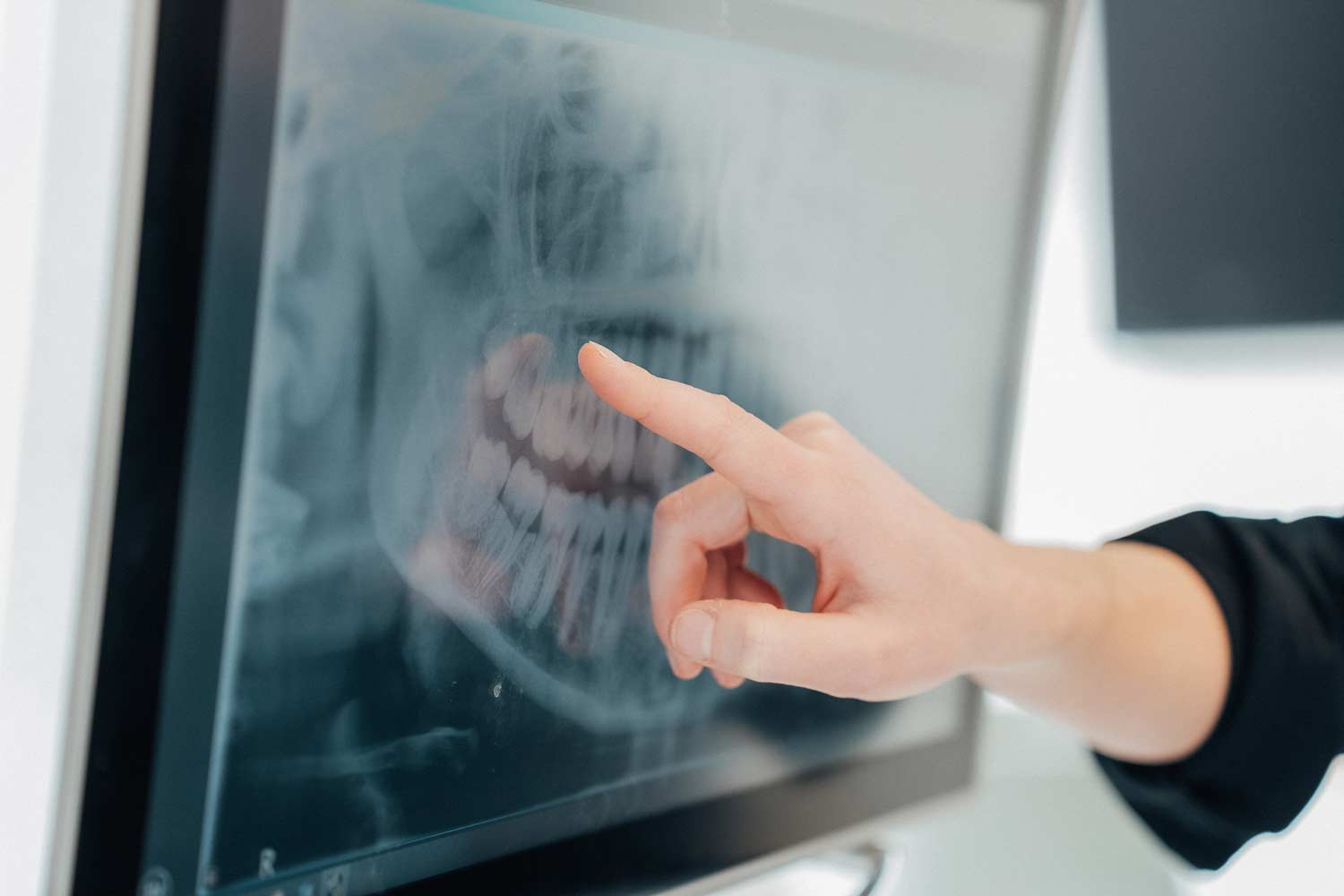 Nahaufnahme eines Fingers, der auf ein Röntgenbild eines Gebisses zeigt